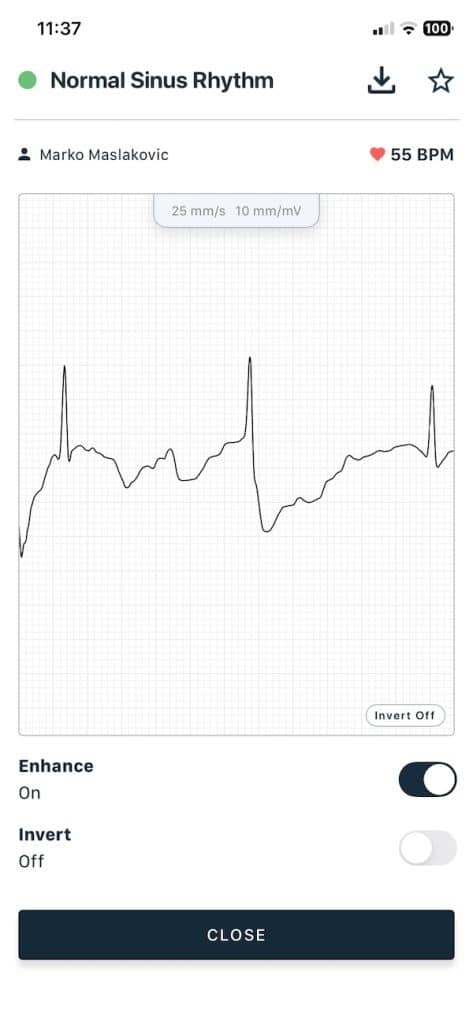 KardiaMobile 6L single lead reading