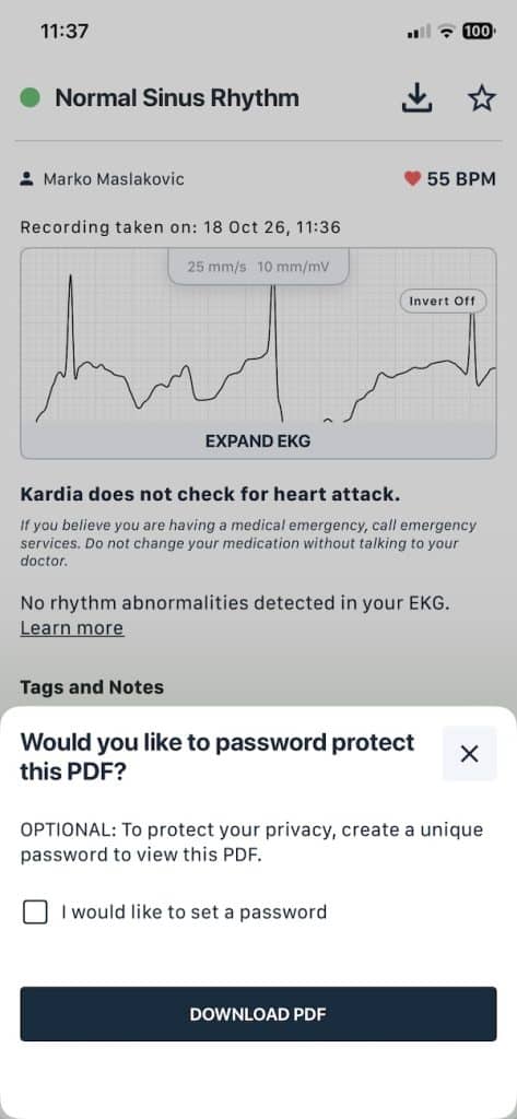 KardiaMobile 6L single lead reading