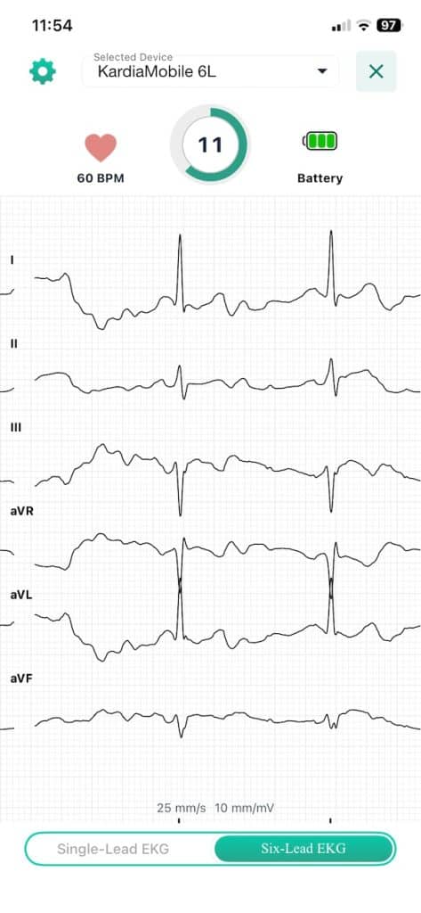 KardiaMobile 6L six lead reading