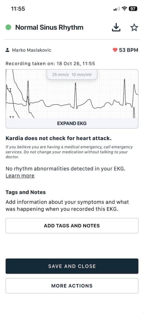 KardiaMobile 6L six lead reading