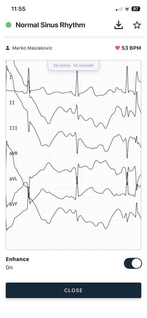 KardiaMobile 6L six lead reading